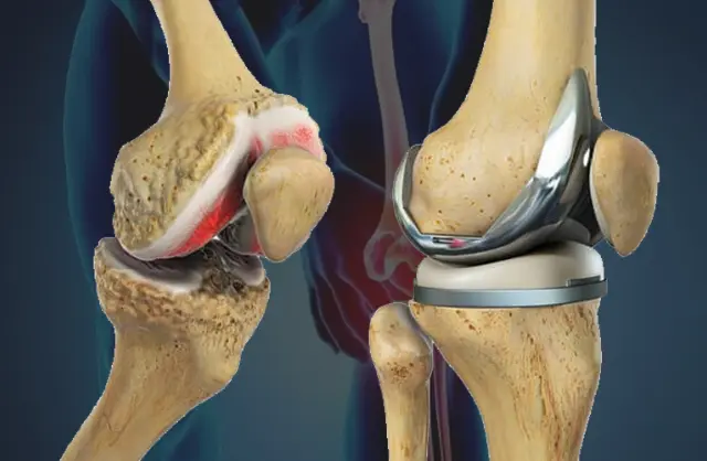 Knee & Hip Replacement in India for Zimbabwe Patients 